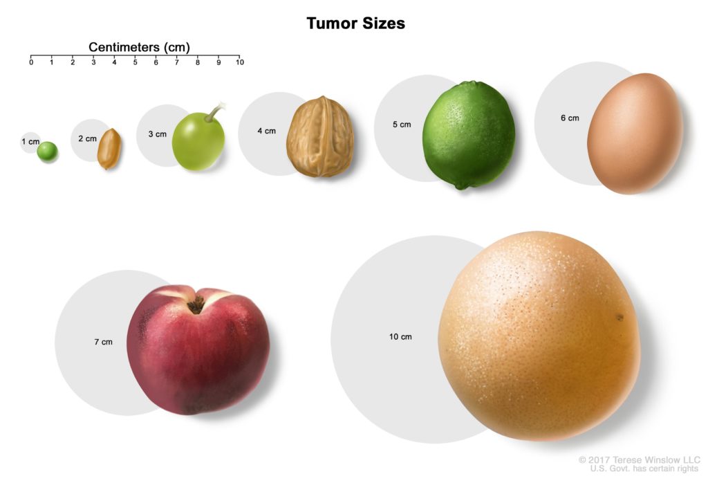 second-opinion-said-it-was-actually-a-strawberry-sized-tumor-this-is